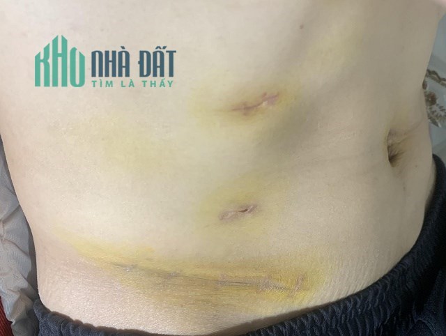 Cần các Anh/Chị muốn HT cứu người nhóm máu AB . A . O . B, tuổi từ 19 đến 43 tuổi từ có pháp lý đến