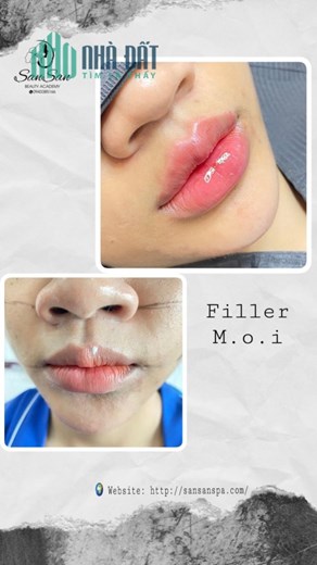 SAN SAN BEAUTY CHƯƠNG TRÌNH SIÊU ƯU ĐÃI DỊCH VỤ FILLER CHỈ CÒN 999K/1cc C.ấ.y Collagen HA chỉ #999k
